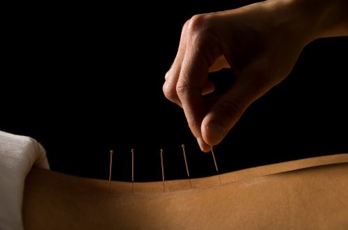 Acupuncture